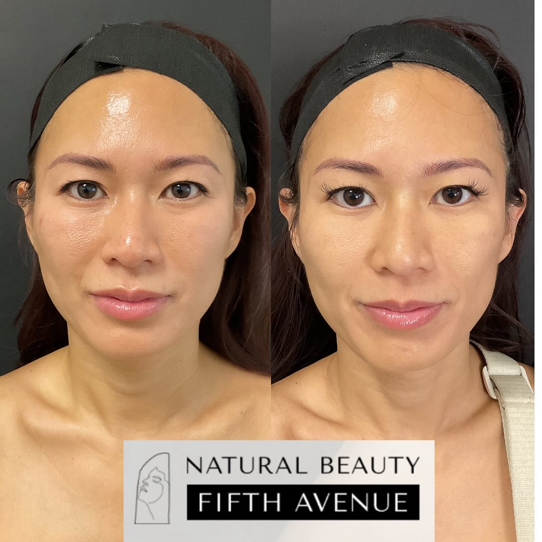 Before and after RF microneedling results showing improved skin texture and radiance on patient's face